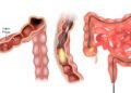 Os hábitos que ajudam a proteger o intestino e reduzir o risco de câncer