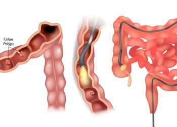Os hábitos que ajudam a proteger o intestino e reduzir o risco de câncer
