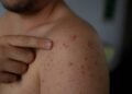 Pequenas manchas na boca podem indicar sarampo e antecipar o diagnóstico