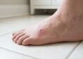 A ferida no pé que demora a fechar pode ser o sinal que muita gente ignora antes de descobrir o diabetes