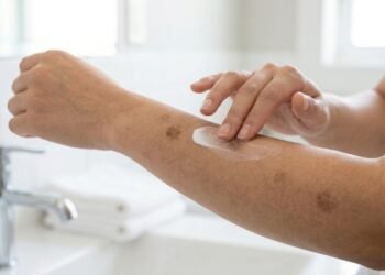 Como reduzir manchas escuras no corpo após os 50 anos