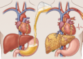 O que a "cerveja" faz no fígado e na saúde cardiovascular.