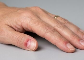 Unhas com lunulas avermelhadas exigem mais atenção quando a mudança persiste, alertam especialistas: o que pode indicar esse sinal no corpo.