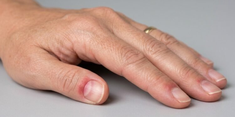 Unhas com lunulas avermelhadas exigem mais atenção quando a mudança persiste, alertam especialistas: o que pode indicar esse sinal no corpo.