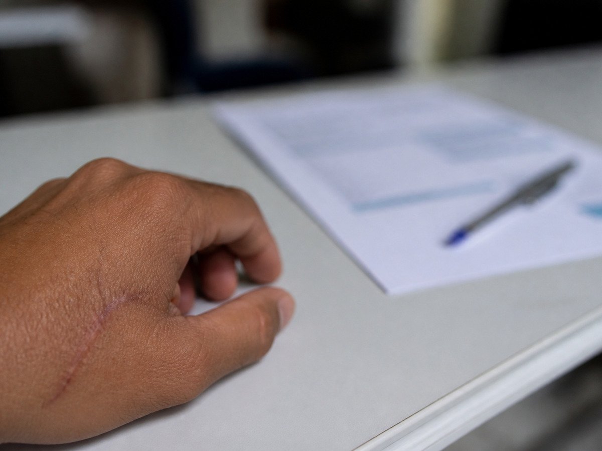 Mão com cicatriz sobre o extrato do benefício do INSS